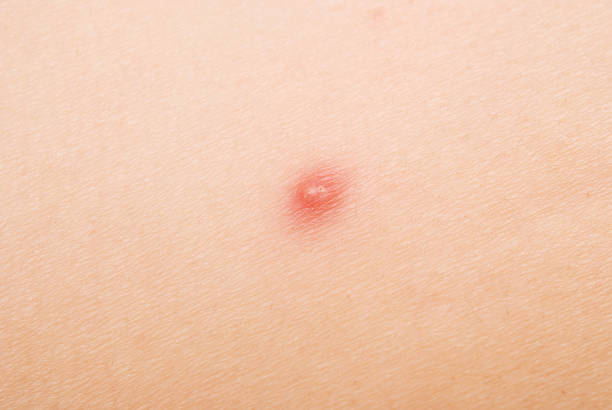 Acne e Ginecologo: la mia esperienza