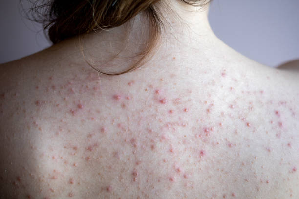 Acne Neonatale: Cos’è e Come ci si Comporta [Guida Completa]