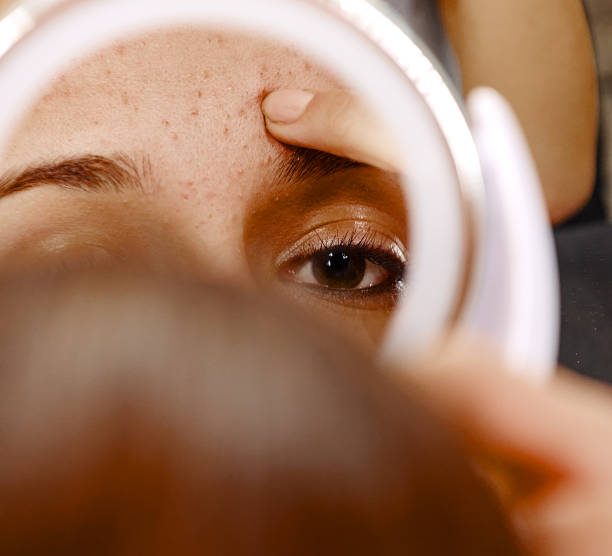Acne Ormonale Maschile e Femminile: Cos’è, Cure e Rimedi