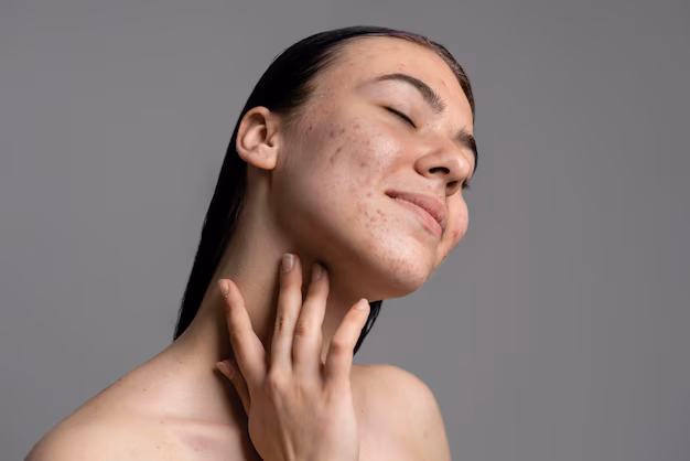 Qual’è il Miglior Antibiotico per Acne? Il Trattamento e Quando Usarli