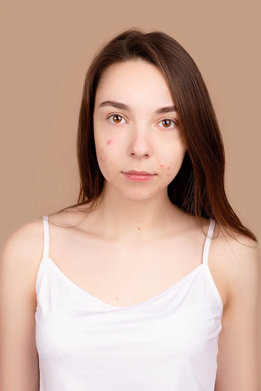 Benzac contro l’Acne (Perossido di Benzoile): Funziona davvero?