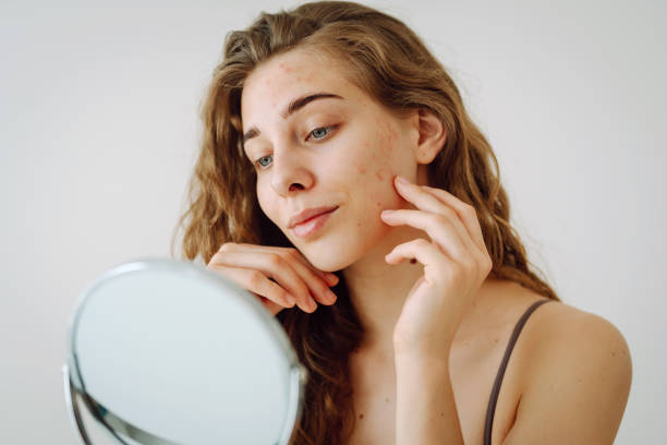 Curare le Cicatrici da Acne: Rimedi Naturali per Eliminarle