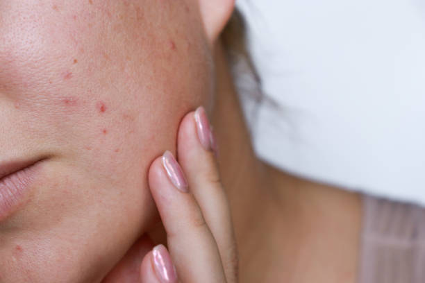 Giulia de Lellis e il suo Acne