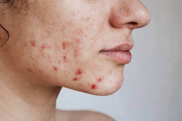 Kendall Jenner e l’Acne: la sua Storia