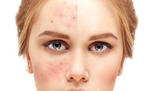 Metodi e Rimedi Laser per Togliere l’Acne: Durata, Effetti e Costi